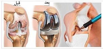 تعویض-مفصل-زانو بهترین دکتر زانو از علت خونریزی مفصل زانو که با چه علائمی همراه است و چه روش های غیر جراحی برای درمان همارتروز زانو در اصفهان وجود دارد