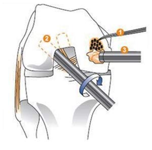 روش های غیر جراحی علائم و درمان آرتروز و ساییدگی مفصل زانو