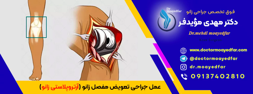 best doctor Knee arthroplasty iran بهترین دکتر جراح عمل جراحی تعویض مفصل زانو آرتروپلاستی زانو در اصفهان