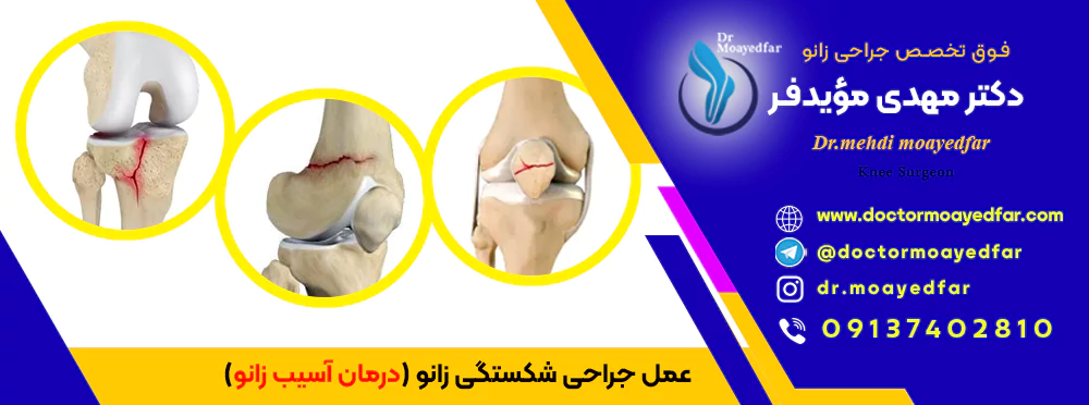best doctor Knee fractures iran بهترین دکتر جراح عمل جراحی شکستگی زانو درمان آسیب زانو در اصفهان