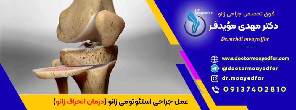 best doctor Knee osteotomy iran بهترین دکتر جراح عمل جراحی استئوتومی زانو برای درمان انحراف و کجی زانو در اصفهان