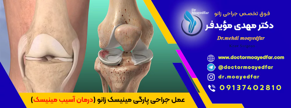 best doctor Meniscus tear of the knee iran بهترین دکتر عمل جراحی پارگی مینیسک زانو و درمان آسیب مینیسک در اصفهان